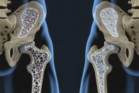 بیماری پوکی استخوان: علایم و شیوع تا درمان